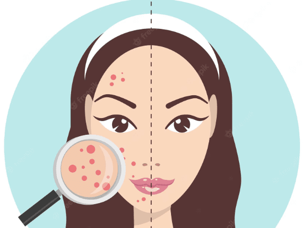 Topical Clindamycin: A Guide for Acne Treatment