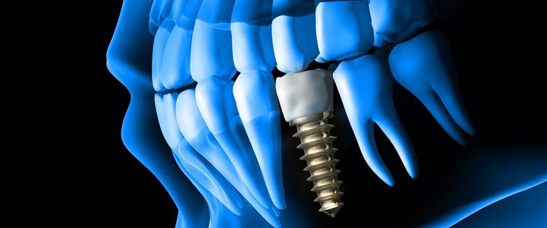 Best medical center for Dental Implant in Dubai